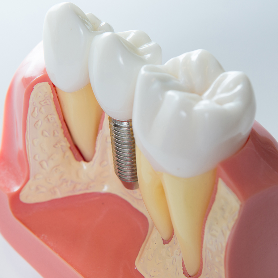 インプラント治療